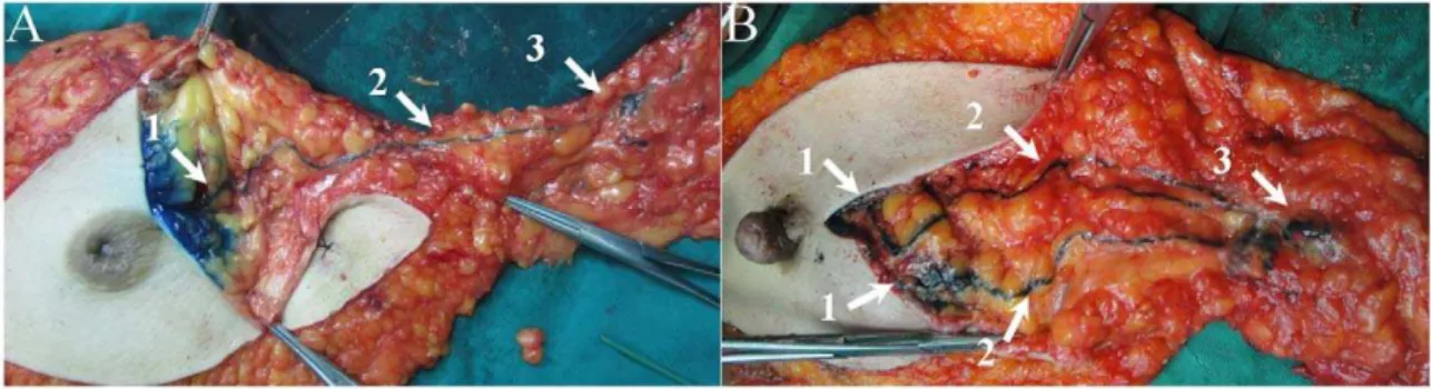 Figure 3. Representative blue DSLCs obtained after single peritumor injection of methylene blue dye postoperatively (back side of the breast), revealing that pathways of lymph flow arise from the peritumor parenchyma, pass through the retromammary tissue a