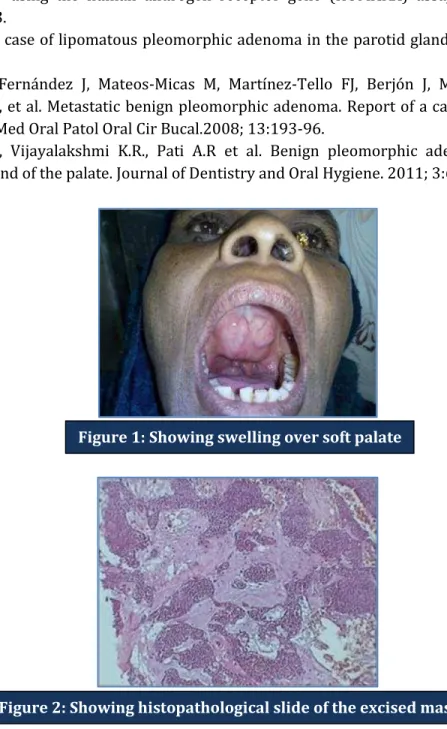 Figure 2: Showing histopathological slide of the excised massFigure 1: Showing swelling over soft palate