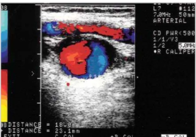 Fig. 1 – Photography of  colour Doppler result showing right axillary  artery pseudoaneurysm