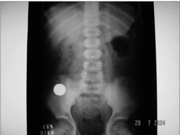 Figure 5. Case 6: 2.5cm coin that spontaneously descended to the  gastrointestinal tract.