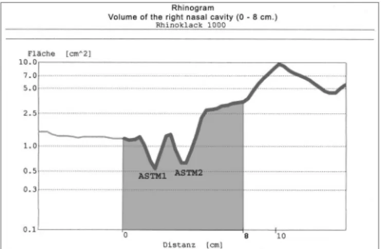 Table 1. Average pre and post-vasoconstrictor nasal cavity volumes,  before and after FESS, in cm3.