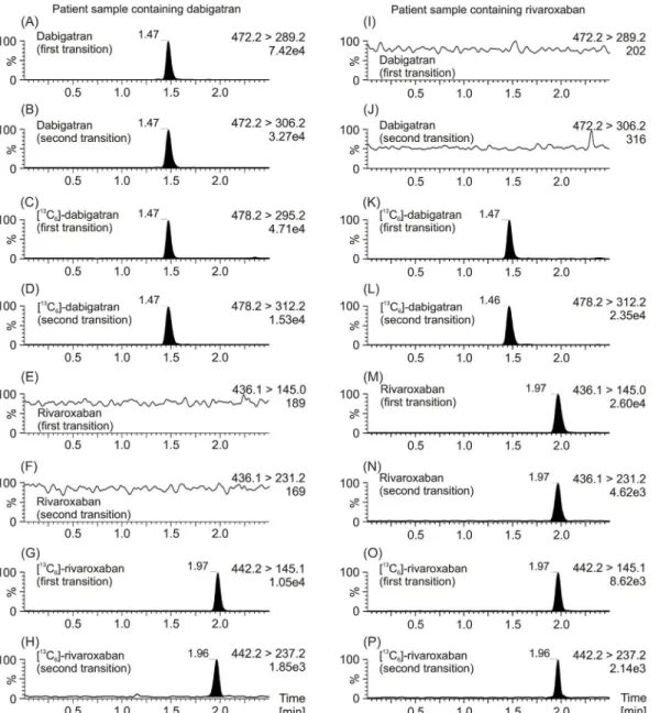 Fig 2. MRM chromatograms of patients ’ plasma samples. MRM chromatograms of a plasma sample from a patient which have been treated with dabigatran are depicted on the left (A, B, E, F), as well as MRM chromatograms a plasma sample from a patient which have
