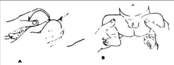 FIGURE 6a.  A normal sonogram of the hips of the same child with the  oblique pelvis.