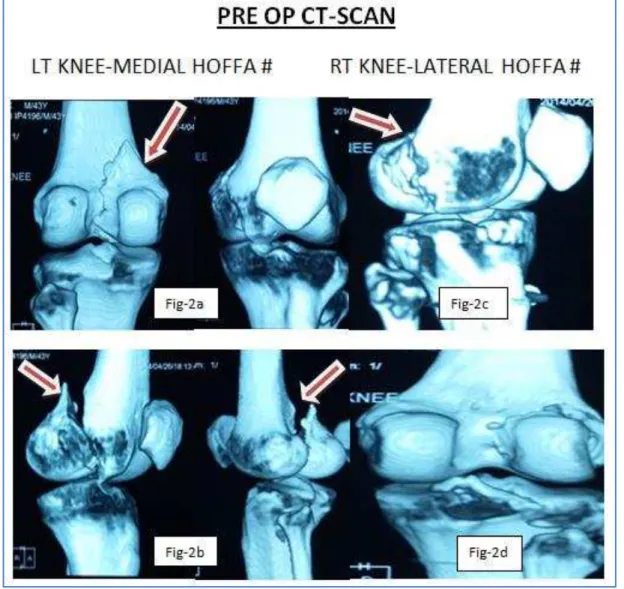 Fig. 2a &amp; 2b: Pre-op CT scan LT knee; Fig. 2c &amp; 2d: pre-op CT scan RT knee 