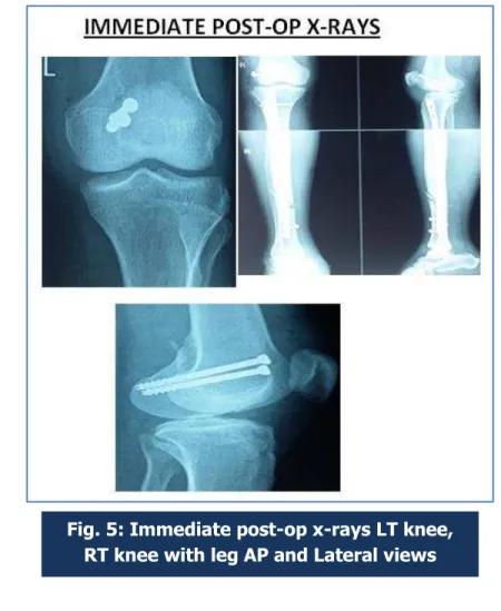 Fig. 5: Immediate post-op x-rays LT knee,  RT knee with leg AP and Lateral views