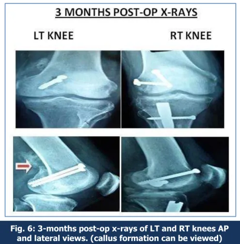 Fig. 7: 9-months post-op x-rays LT and RT knees AP and lateral views 