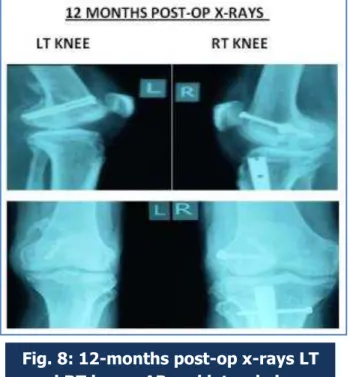 Fig. 9: Immediate post-op ROM LT and RT knee joints