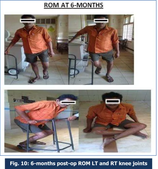 Fig. 10: 6-months post-op ROM LT and RT knee joints