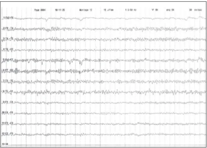 Figure 1. Bilateral discharges of polyspikes and spike-wave complexes  (paroxysms)