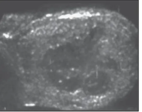 Figure 7. Testicular hematoma. Anechoic paren- paren-chymal collection surrounded by irregular  hypo-echoic areas.