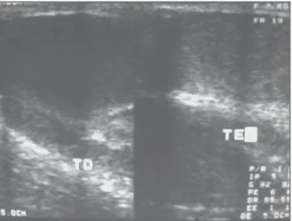 Figure 13. Testicular abscess. Orchitis complica- complica-tion. Heterogeneous parenchymal collection with irregular limits, occupying practically the whole  tes-tis.