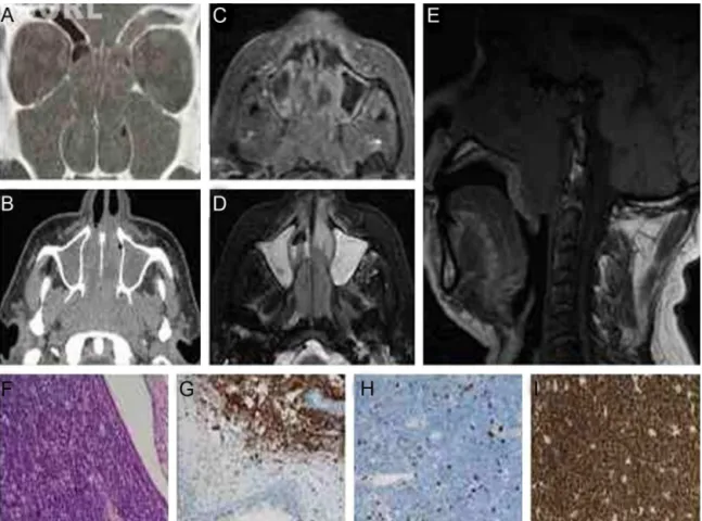 Figure 1 Computed tomography of paranasal sinuses. (A) Coronal view, bone window and (B) axial view, soft tissue window, with a soft tissue density lesion in the nasopharynx, nasal cavity, and sinuses; magnetic resonance imaging of paranasal sinuses, (C) a