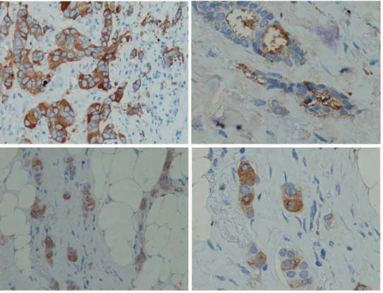 Figure 5. Breast cancer tissue immunohistochemistry stainings. MUC1 was stained with IIB6 (5 mg/ml), mouse anti-his (1:1000) (Qiagen, Hilden), rabbit-anti-mouse antibody (1:250) and detected by Peroxidase complex after Thyramine amplification (1:200).