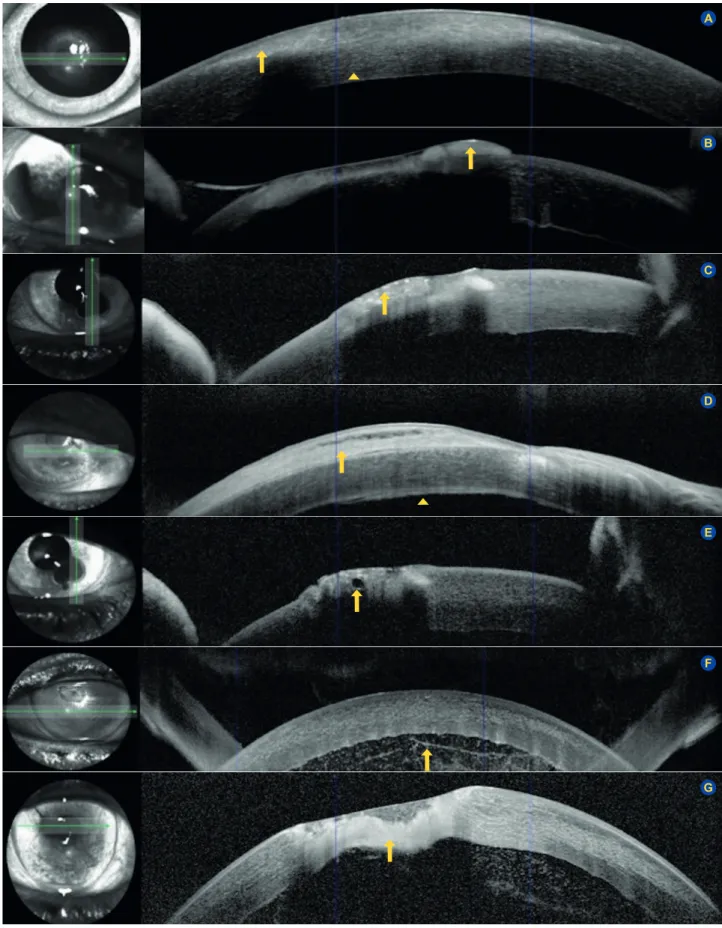 Figure 3 – Different anterior segment optical coherence tomography patterns in infectious keratitis