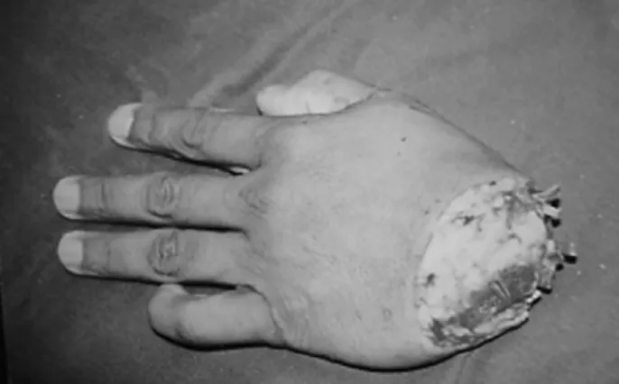 Figure 1 - Left hand amputated at the level of the wrist (case 1)