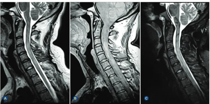 Figure 2 – Sagittal cervical spinal cord images. (A) T2-weighted fast spin-echo. (B) Proton-density (acquired at dual-echo)