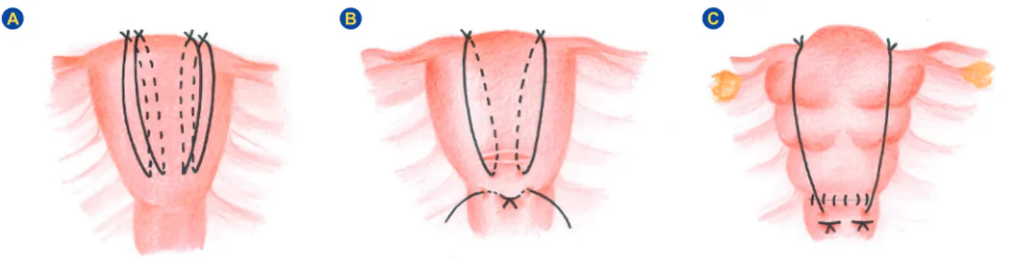 Figure 4 – Scheme of Hayman’s et al 24  suture technique. (A) Anterior aspect of the uterus after a vaginal delivery, when no hysterotomy  was  needed