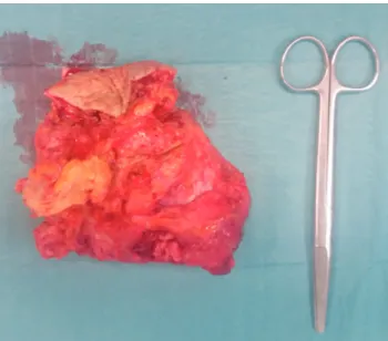 Figure 4 – Surgical specimen of the excisional biopsy