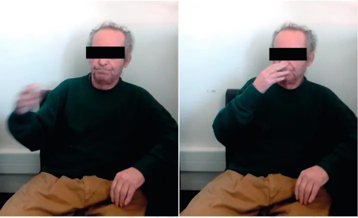 Figure 3 – Finger nose test (0 to 15 seconds); Tying his shoes (15 to 30 seconds); Visiting the inpatients unit after discharge (30 to 50  seconds); (see Video 3: https://www.actamedicaportuguesa.com/revista/index.php/amp/article/view/13029/Video_03.mp4)