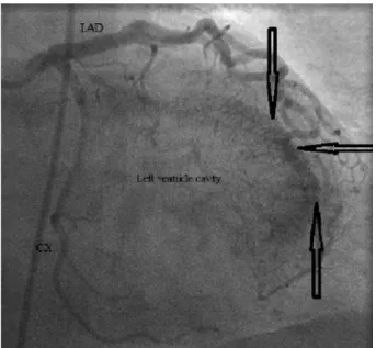 Figure 1.  Right anterior oblique view showing the  multiple microistulas draining into the left ventricle