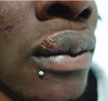 Figure 3 – Herpes simplex infection of the upper lip. In this patient,  HSV-2 was identified by polymerase chain reaction