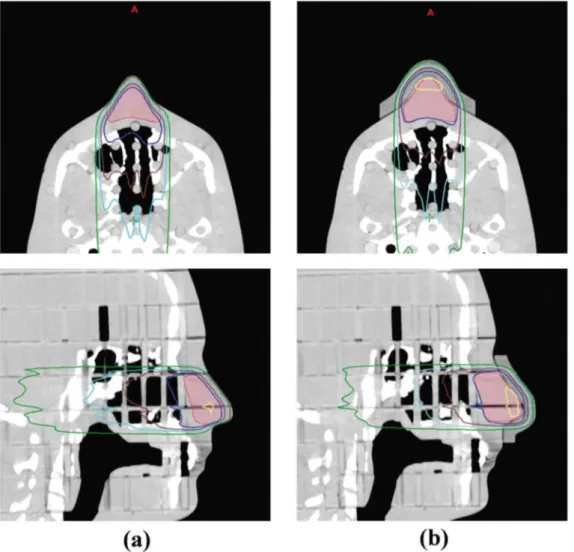 Figure 5. Dose distributions of the two treatment plans from the RANDO phantom study. (a) Plan without a bolus, (b) plan with the 3D printed customized bolus