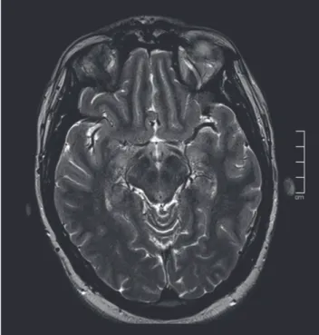 Figura 4 – Medula (sagital T2)virais  exantemáticas.  Porém,  a  maior  coorte  publicada  à 