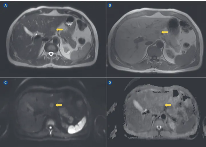 Figure 1 – Typical MR findings of MRN in a case developing after chemotherapy for rectal cancer
