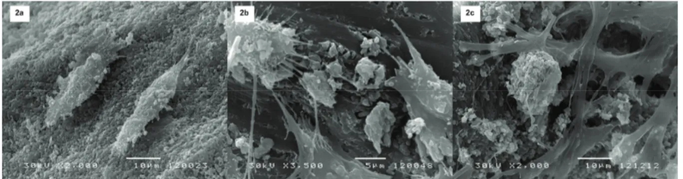 Figure 4. Scanning electron microscopy of dental pulp stem cells from deciduous teeth on Albo-Oss (porous hydroxyapatite + PLGA  composite) scaffold: a) Spherical cells with cytoplasmic extensions indicate good cell adhesion after 7 days in control medium;