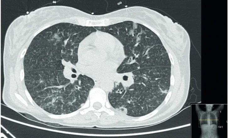 Figure 4 – Chest CT showing scattered and multifocal ground glass opacities and densities, septal thickening and micronodulation (day 1) for adults born on or after 1970 without previous measles  history is one single dose