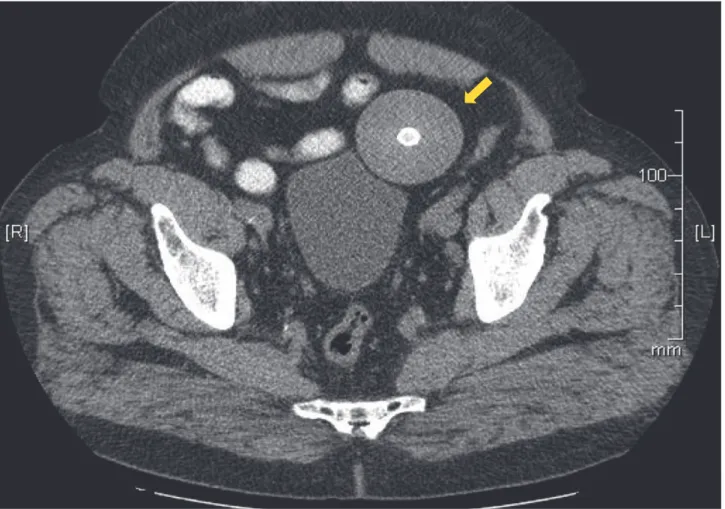 Figura 1 – Tomografia computorizada evidencia imagem esférica na cavidade pélvica em contacto com a bexiga (seta)