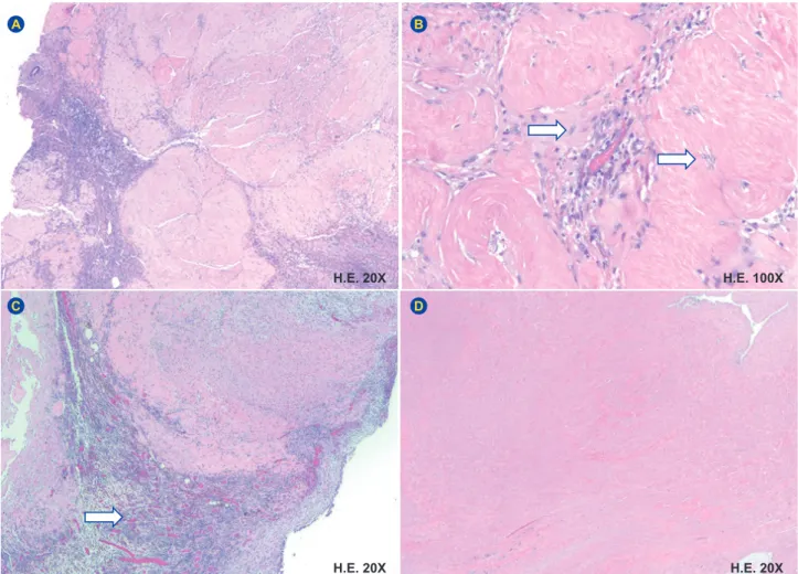 Figure 4 – Microscopy: Multilobular proliferation of a sparsely cellular hyalinized tissue (A), with foci of granulation tissue (C – arrow) and  coagulative necrosis (D); with absence of mitotic figures and atypia (B - arrows)