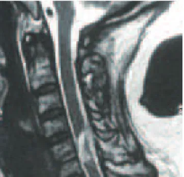 Fig 2. A T2-weight image of cervical spine in patient with  central cord syndrome due to traumatic herniated disc.