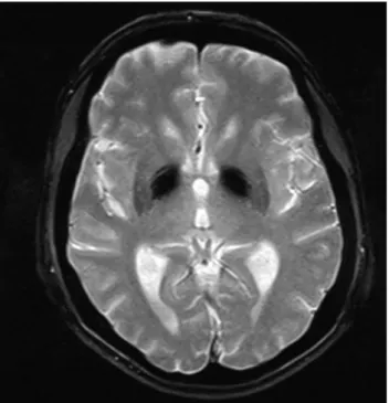 Figure 5 – Muscular biopsy with ragged red fibres, hematoxylin eo- eo-sin (H-E)