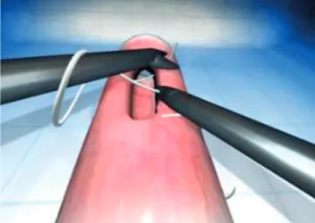 Figure 2 – Representation of the simulated procedure (advanced  task 5: anastomosis)