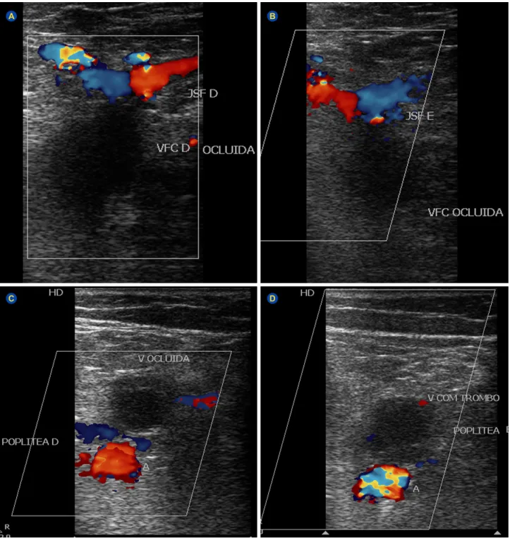 Figure 1 – Doppler ultrasound examination of the inferior limbs shows thrombotic obstruction of both right (A) and left (B) common femoral  veins and right (C) and left (D) popliteal veins