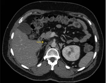 Figure 2 – Axial abdominal computed tomography shows absence  of the suprarenal segment of inferior vena cava (arrow)