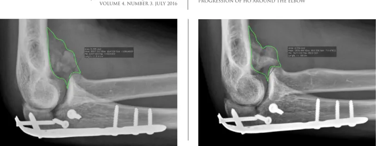 Figure 1. Lateral radiographs a few weeks (A) and several months (B) after open reduction and internal fixation of an olecranon fracture- fracture-dislocation shows little change in the area of heterotopic ossification