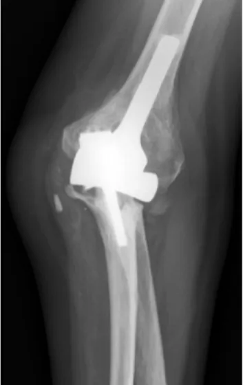 Figure 4 – Implant loss