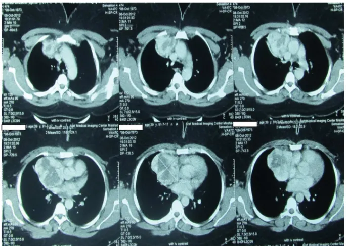 Figure 1.  Multislices thoracic CT in axial slices shows mediastinal mass extending from suprasternal notch to above liver.