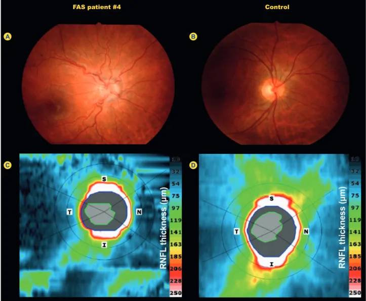 Figure 1 - Representative optic disc fundus photography (A and B) and OCT peripapillary RNFL thickness map (C and D) of a FAS patient  (#4) and a control subject