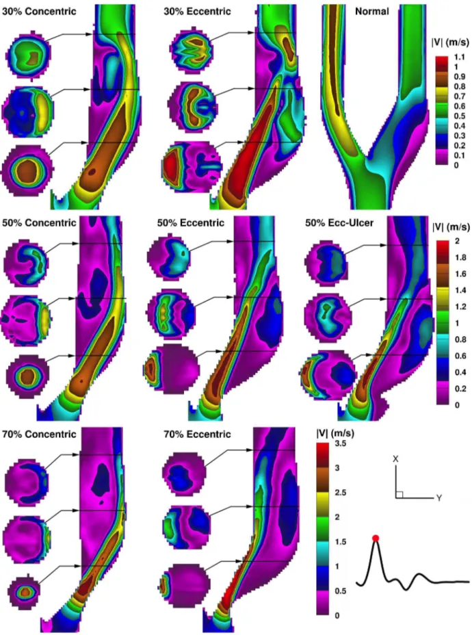 Figure 3. Color maps of ensemble-averaged velocity magnitudes shown for peak systole in a family of eight carotid bifurcation models