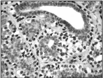 Figure 2 – Positive reaction to the calponin marker in myoepithelial cells (IHQ 400×) IHQ: immunohistochemical.