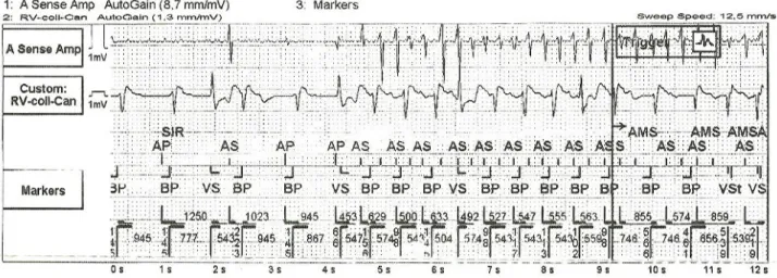 Figura 1 – Exemplo de um episódio de fibrilhação auricular com 38 seg de duração detectado casualmente numa consulta de seguimento  de um doente com dispositivo de ressincronização cardíaca