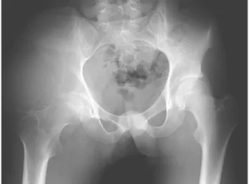 Figura 1 - Radiografia simples da bacia com imagem de lesão ex- ex-pansiva sobre o ilíaco direito