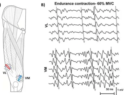 Fig 1. Electrode arrays positions on VL and VM muscles (A) and representation of the EMG signals (B)