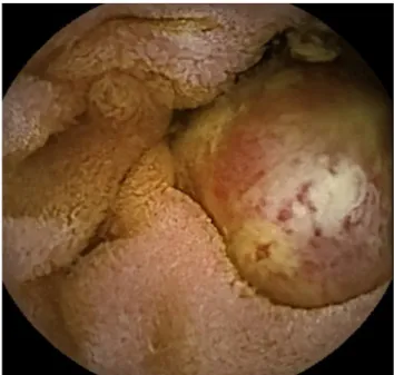 Figure 2 – Small bowel tumorsubsequently  treated  with  DBE  was  35%;  multivariate 
