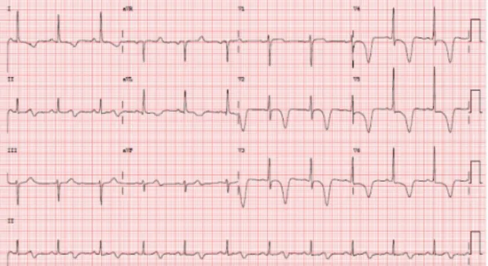 Figura 1 – Electrocardiograma seriado com inversão progressiva  da onda T nas derivações précordiais v2 - v6