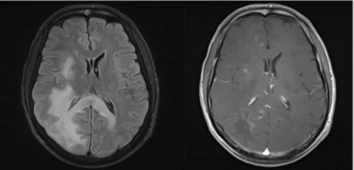 Figure 3 - Axial brain MRI showing a T2 FLAIR hyperintense right fronto-parietal lesion (left) extending to the contralateral side through  the splenium of the corpus callosum with mass effect and patchy enhancement on post-contrast T1-weighted images (rig