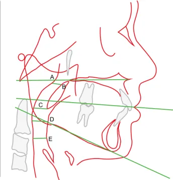 Figure 3 - Pharyngeal airway space variables: A, distance between  PNS and posterior wall of pharynx in ANS-PNS plane; B, superior  McNamara airway space taken on half superior of soft palate  (Npa-Npp) and measured on the narrowed space between soft palat